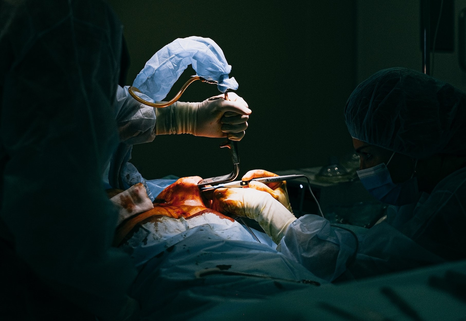 Co gai chet khi nang nguc nam 2021, bac si chi gay te, khong gay me hinh anh