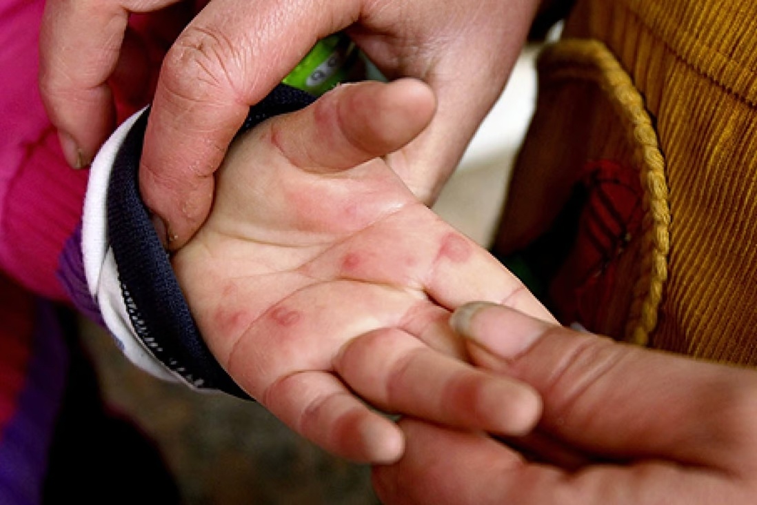 vaccine tay chân miệng ảnh 2 vaccine tay chan mieng anh 2