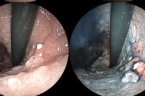 Loai ung thu dang tang nhanh o Dong Nam A khien chuyen gia lo ngai hinh anh