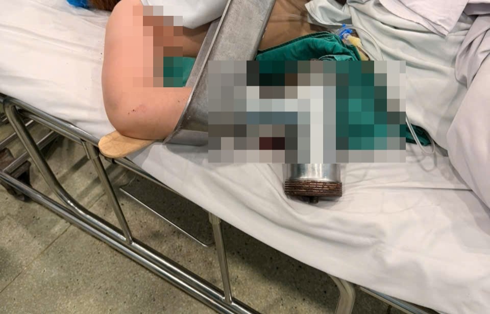 Nhap vien thuong tam voi ban tay ket cung trong may xay hinh anh