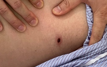 Sot 4 ngay khong dut, nhap vien phat hien 'thu pham' gay benh o dui hinh anh