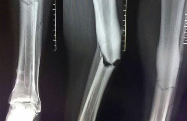 Anh chup X-quang chan thuong kinh hoang cua Demba Ba hinh anh