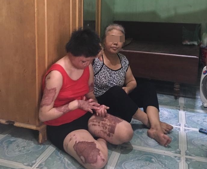 cô gái bị chồng thiêu sống đến biến dạng ảnh 3 co gai bi chong thieu song den bien dang anh 3