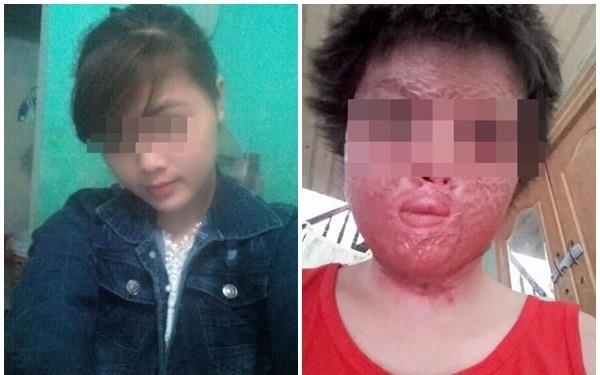 Co gai bien dang guong mat sau khi bi chong dot hinh anh