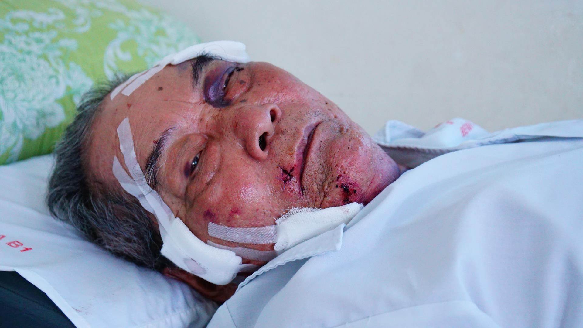 Cu ong 80 tuoi ke luc bi ga xe om danh gay xuong hinh anh