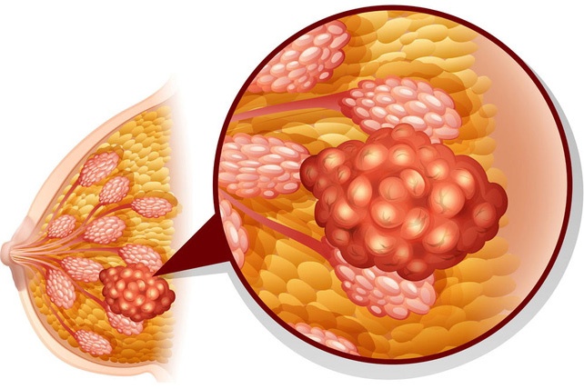 Tai sao chua the chua khoi benh ung thu? hinh anh