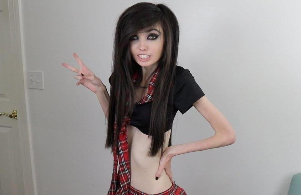 Co gai My bi 'nem da' vi giam can qua da den muc gay tro xuong hinh anh