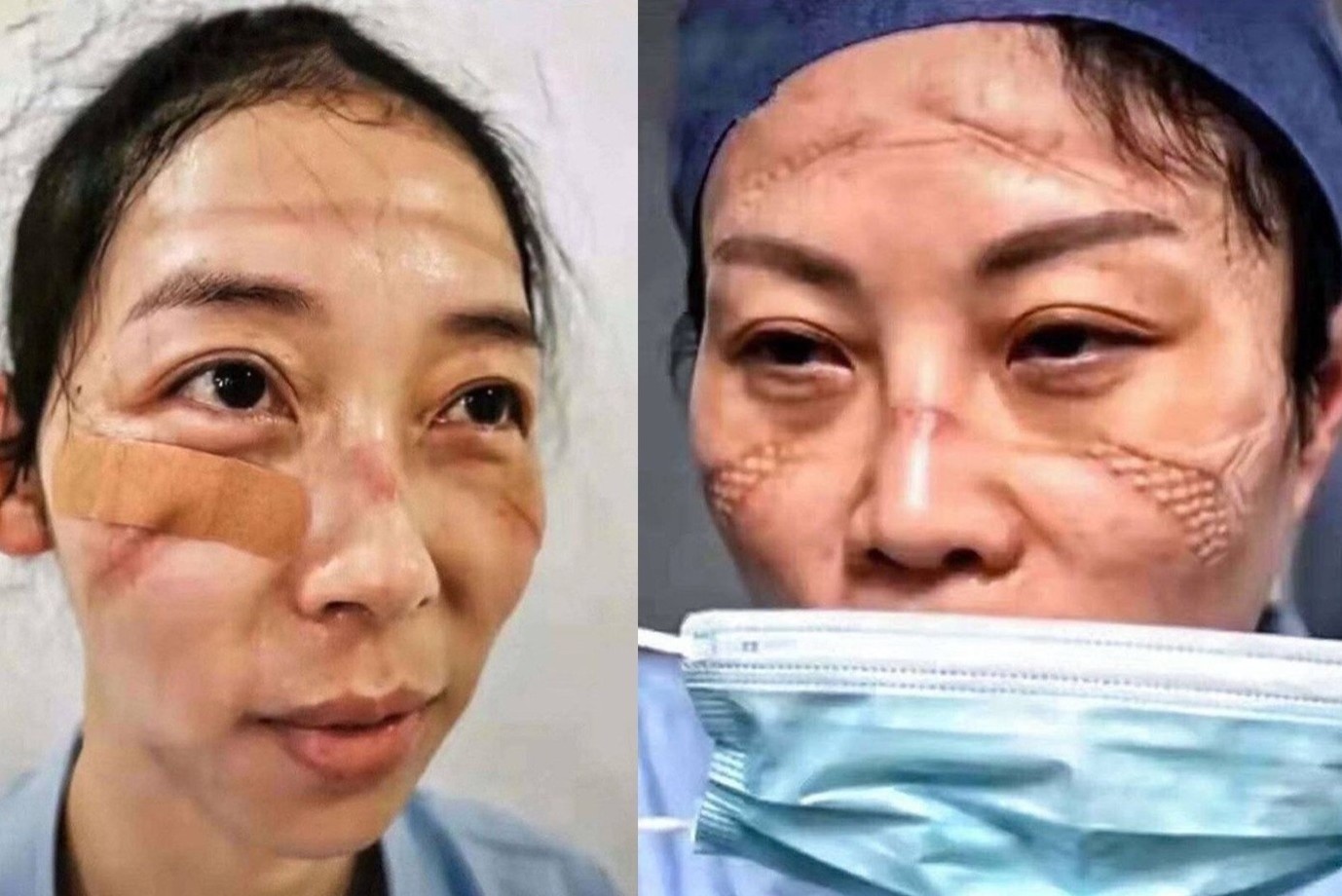 Khuon mat sung do, day vet han cua y bac si o khu cach ly dich corona hinh anh