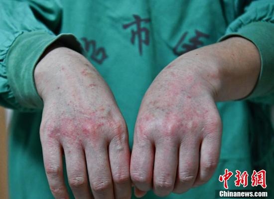 bác sĩ ở khu cách ly corona ảnh 4 bac si o khu cach ly corona anh 4