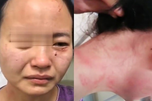 Ngan benh nhan tron khoi khu cach ly, y ta bi hanh hung, can vao mat hinh anh