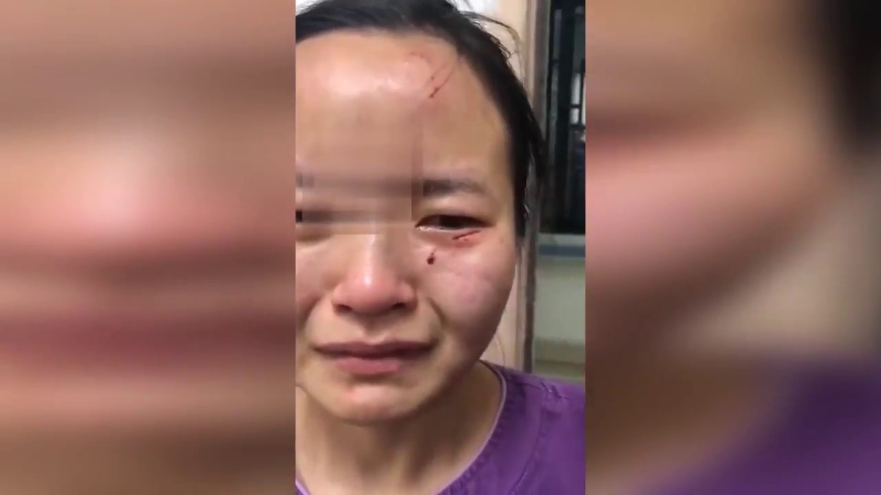 Nu y ta bi benh nhan nhiem virus danh dap, can vao mat hinh anh