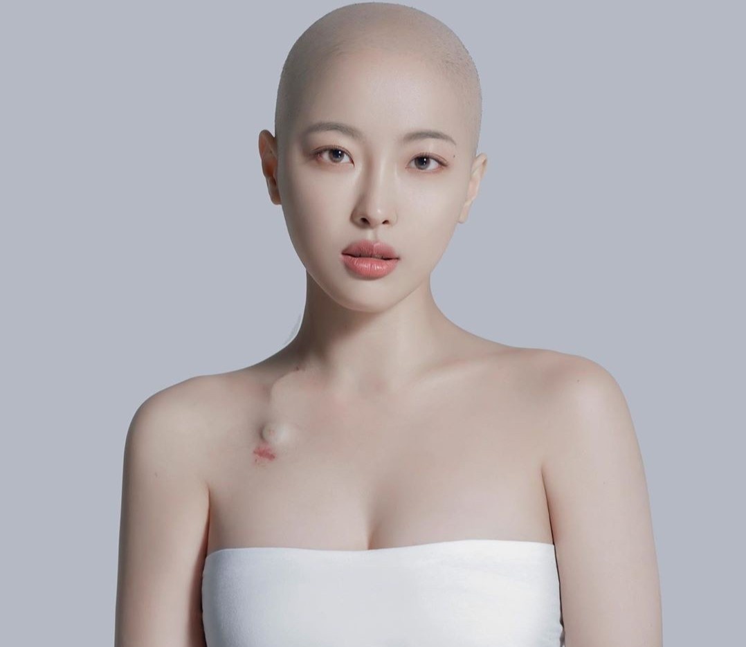 dieu tri ung thu anh 1