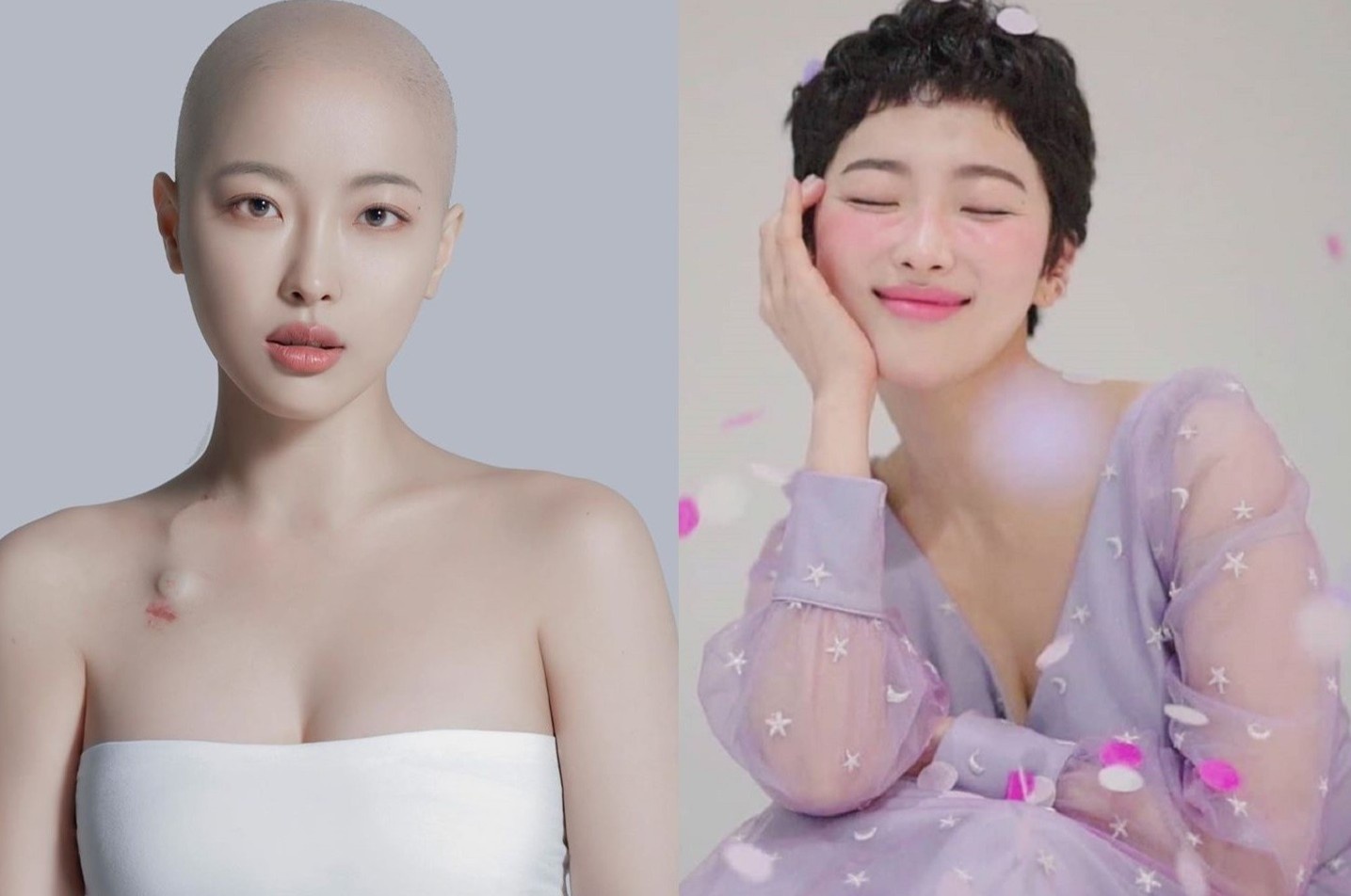 Mot nam chong choi ung thu cua hot girl Han: 'Roi toc se som moc lai' hinh anh