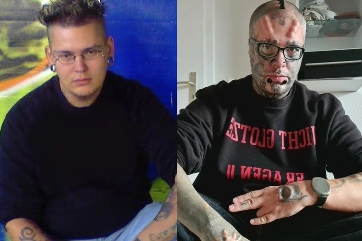 Phau thuat tham my 17 lan de khac nguoi hinh anh