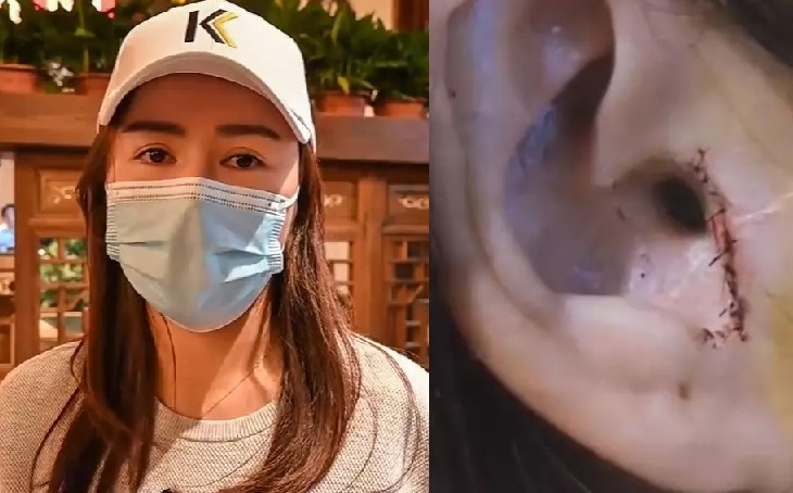 bi cat tai khi phau thuat mui anh 2