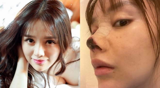 phau thuat tham my chui anh 1