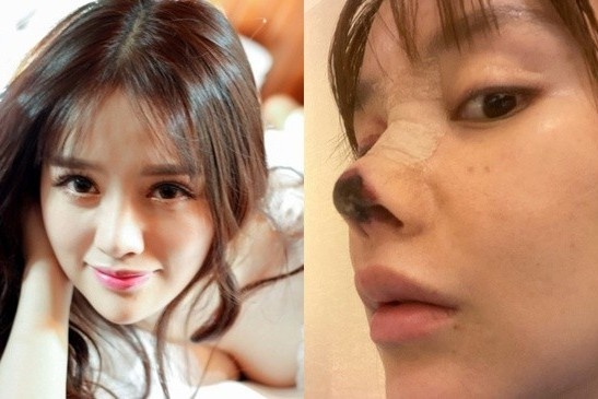 Bi kich cua nhung co gai tre phau thuat tham my hong hinh anh