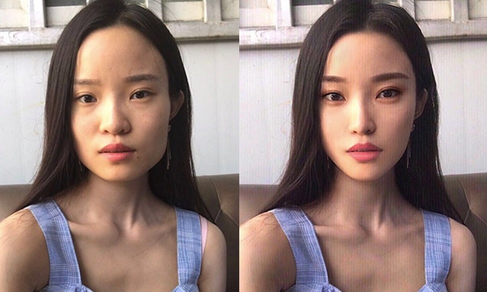 phau thuat tham my chui anh 3