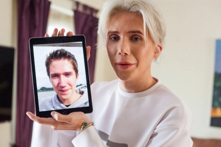 Phau thuat tham my de co guong mat nhu truoc khi dao keo 32 lan hinh anh