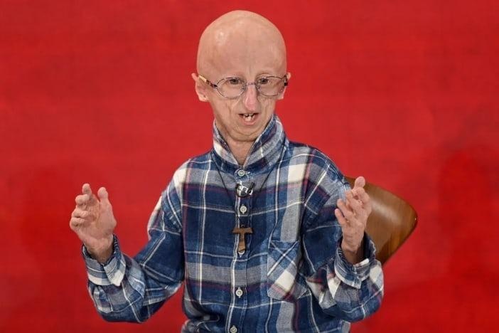 Nguoi mac benh lao hoa nhanh hiem gap qua doi o tuoi 28 hinh anh