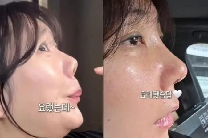 Chiec mui bien dang sau 21 nam phau thuat tham my hinh anh