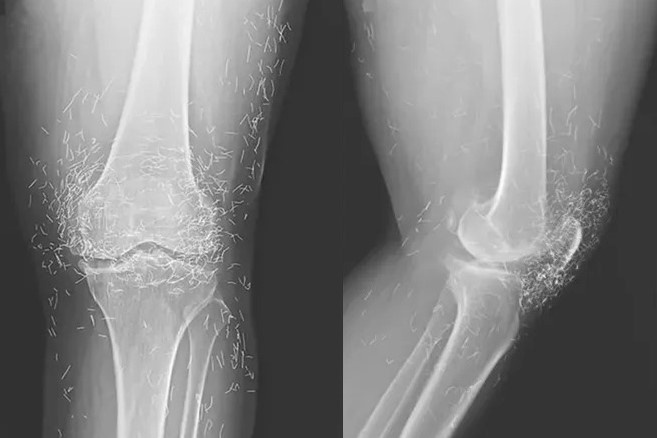 Anh chup X-quang cua benh nhan viem khop sau thoi gian cham cuu ky la hinh anh