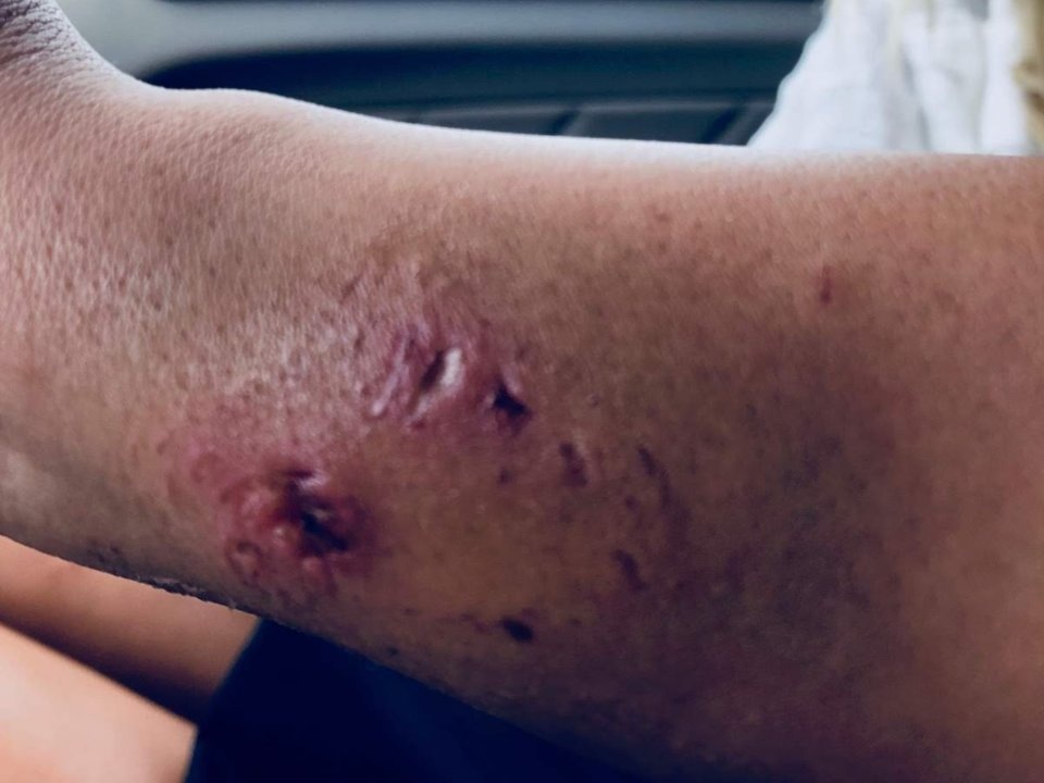 người mẫu bị cá mập cắn ảnh 5 nguoi mau bi ca map can anh 5