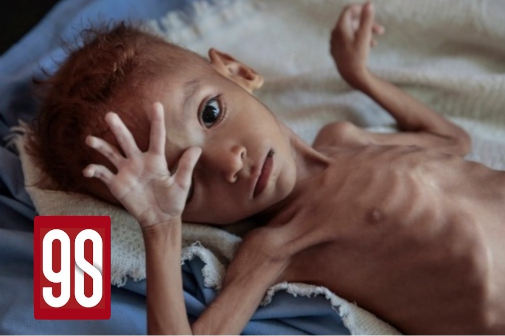 90s: 85.000 em be Yemen da chet vi doi, va se con nhieu tre nua hinh anh