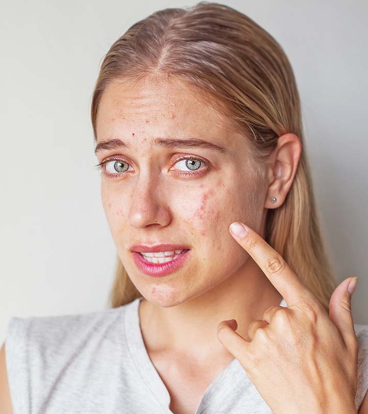 da mụn ảnh 1 da mun anh 1