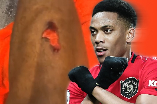 Martial khoe doi chan bi tray da sau khi nhan giai cau thu hay nhat hinh anh