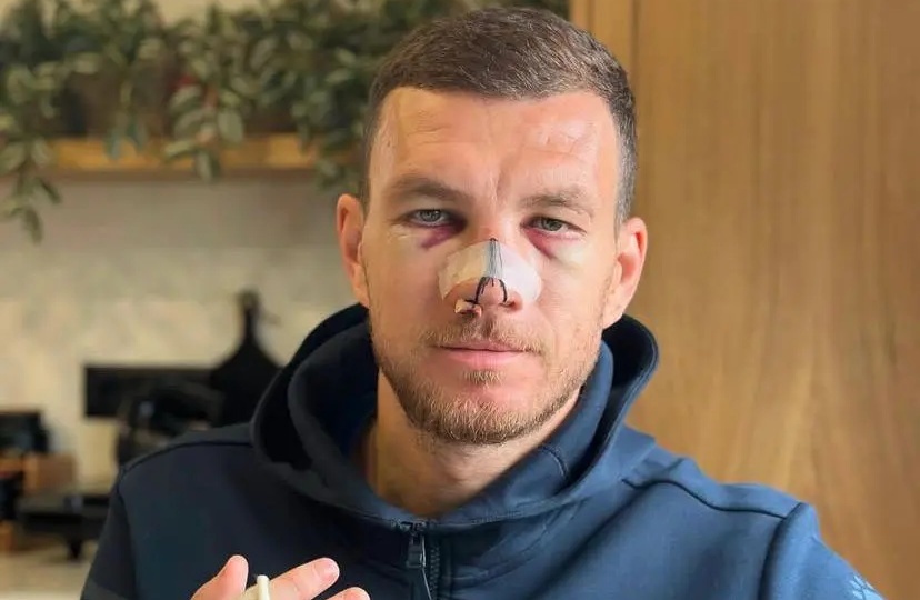 Mat Dzeko bam dap hinh anh