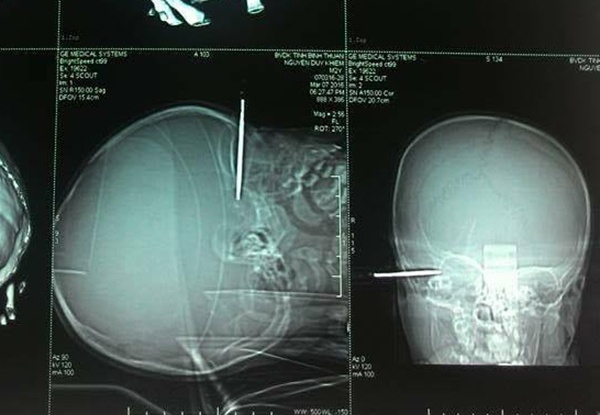 bị vật nhọn đâm thủng đầu ảnh 1 bi vat nhon dam thung dau anh 1