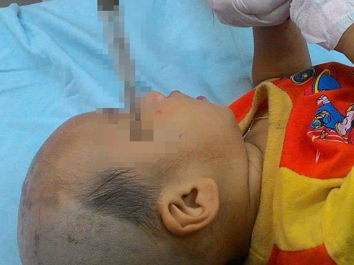 Be 14 thang tuoi bi tuoc no vit dam thung thai duong hinh anh