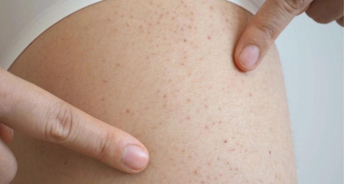 Co gai 19 tuoi mac chung roi loan mau hiem gap sau khi noi ban do hinh anh