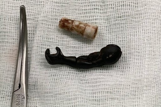 Phat hien 2 di vat la trong vung kin be gai 5 tuoi hinh anh