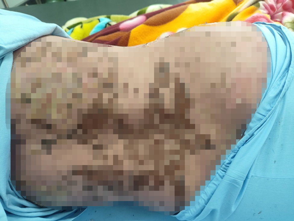 hoi chung Lyell anh 1