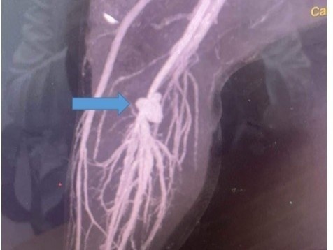 Be trai bi keo dam ton thuong dong mach, suyt phai doan chi hinh anh