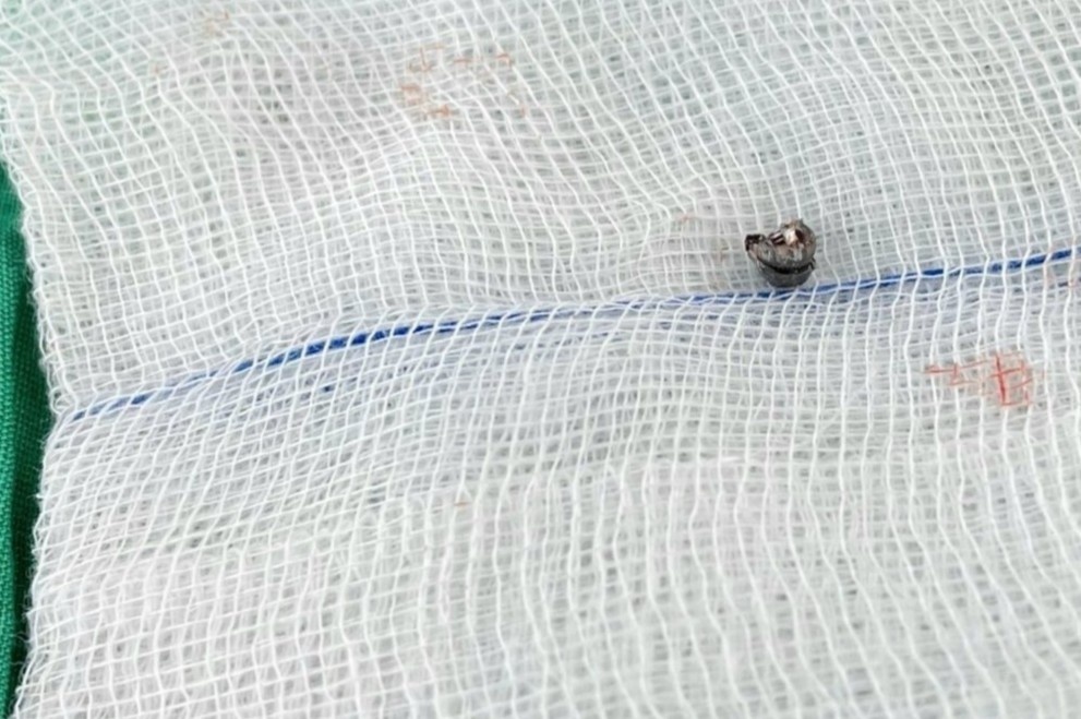 Be trai 10 tuoi bi vien dan chi cam vao xuong so hinh anh