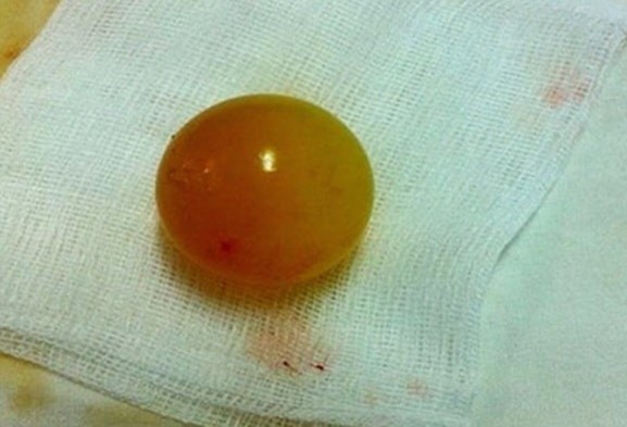 Be gai bi phinh ruot non do nuot hat no hinh anh