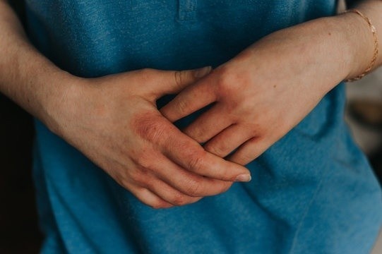 Ai co nguy co mac benh ghe? hinh anh