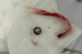 Be gai 3 tuoi nhet pin cuc ao vao mui hinh anh