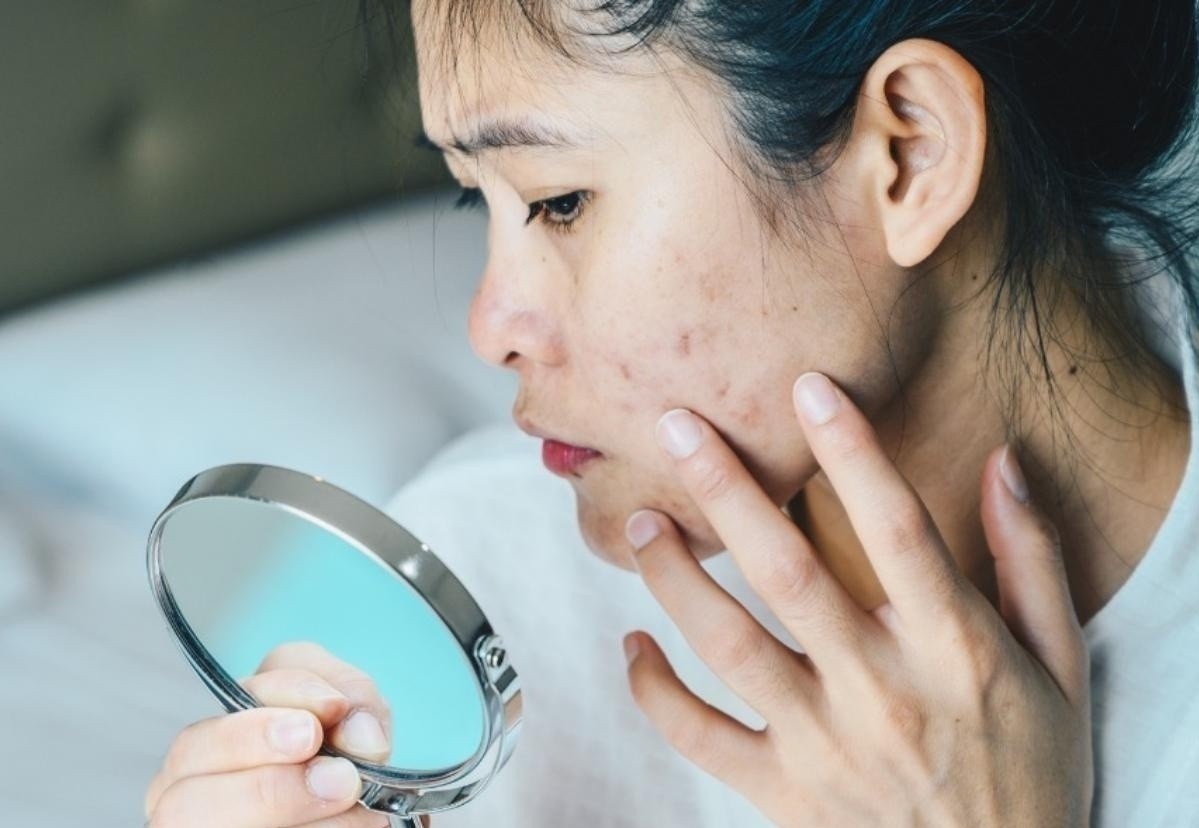 Dau long vi da mun nhung phai trang diem moi ngay hinh anh