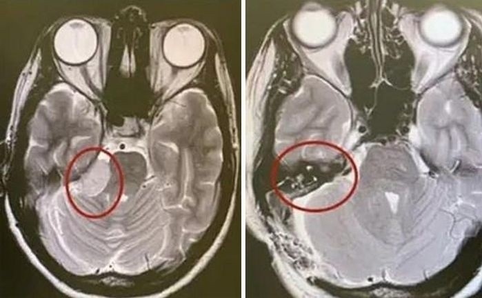 Nguoi phu nu phat hien u nao sau bat thuong khi ngu day hinh anh