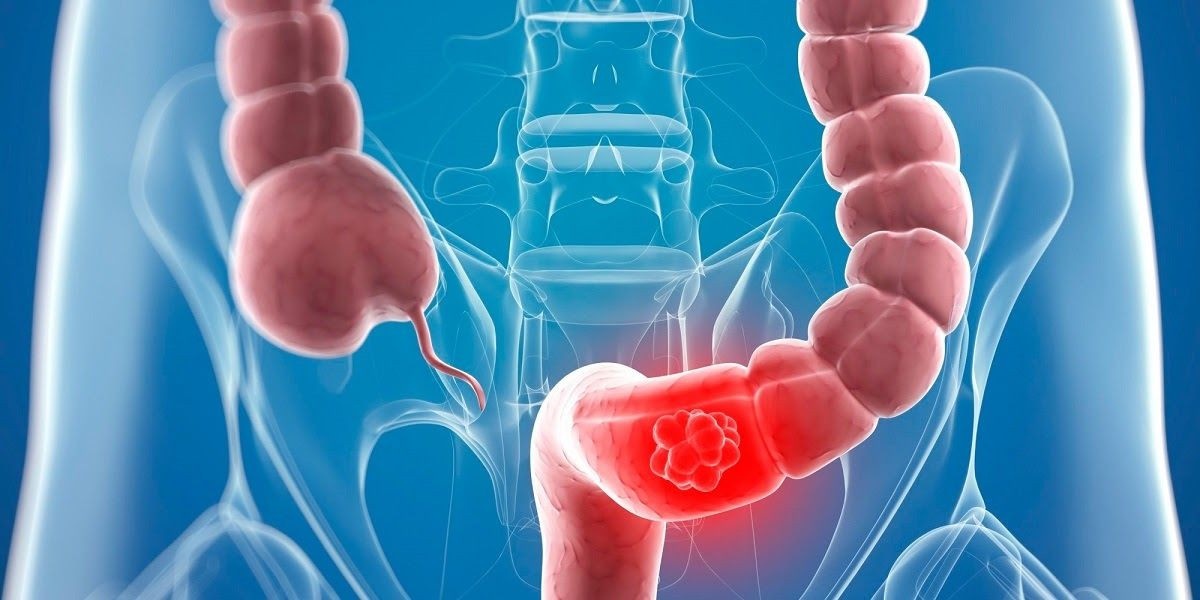 ung thu dai trang anh 1