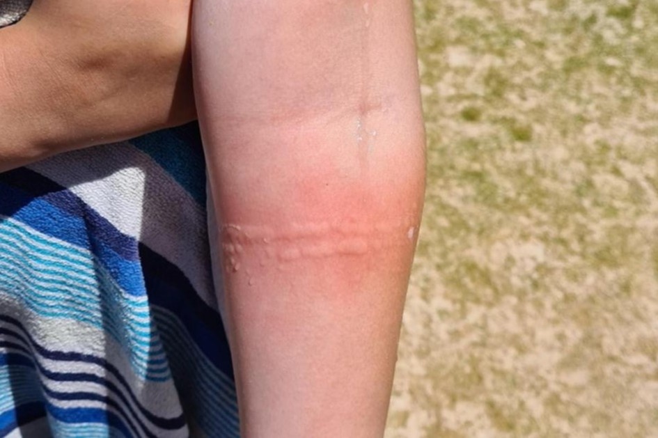 Cach cap cuu khi di bien bi sua 'can' hinh anh