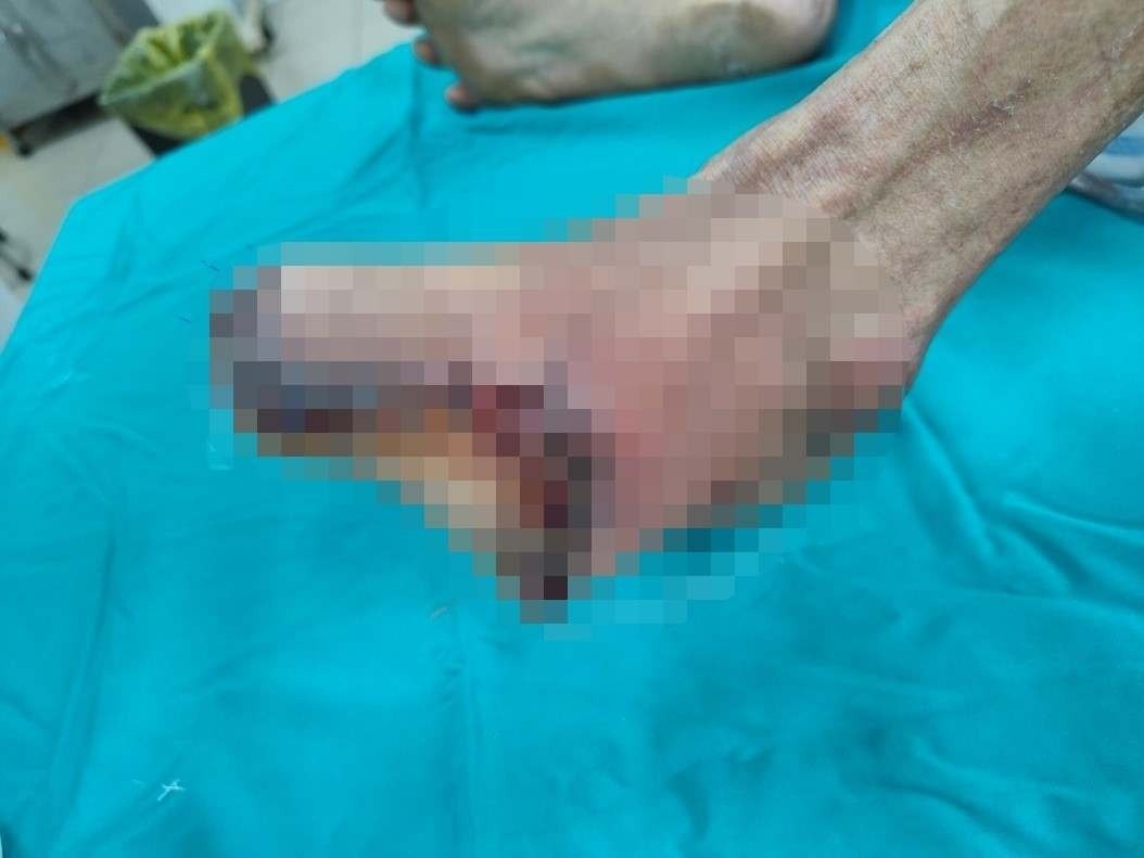 Tu dung thuoc dong y, nguoi dan ong bi hoai tu ban chan hinh anh