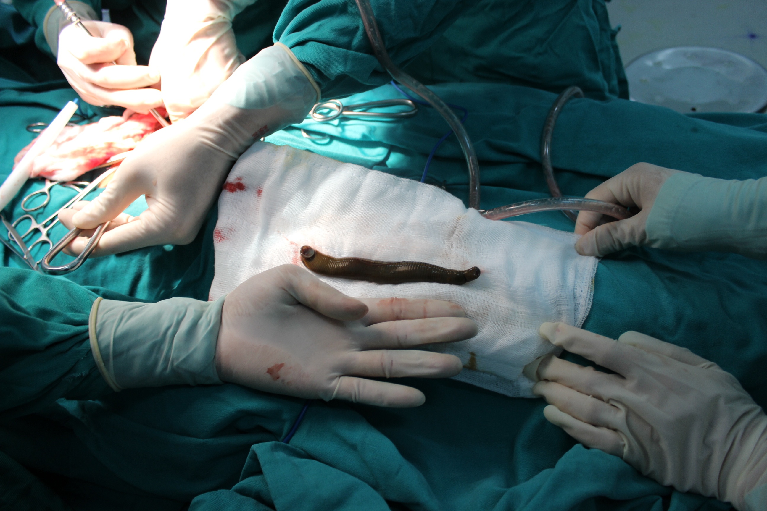 Tam song, bi dia dai gan 20cm chui vao nguoi hinh anh