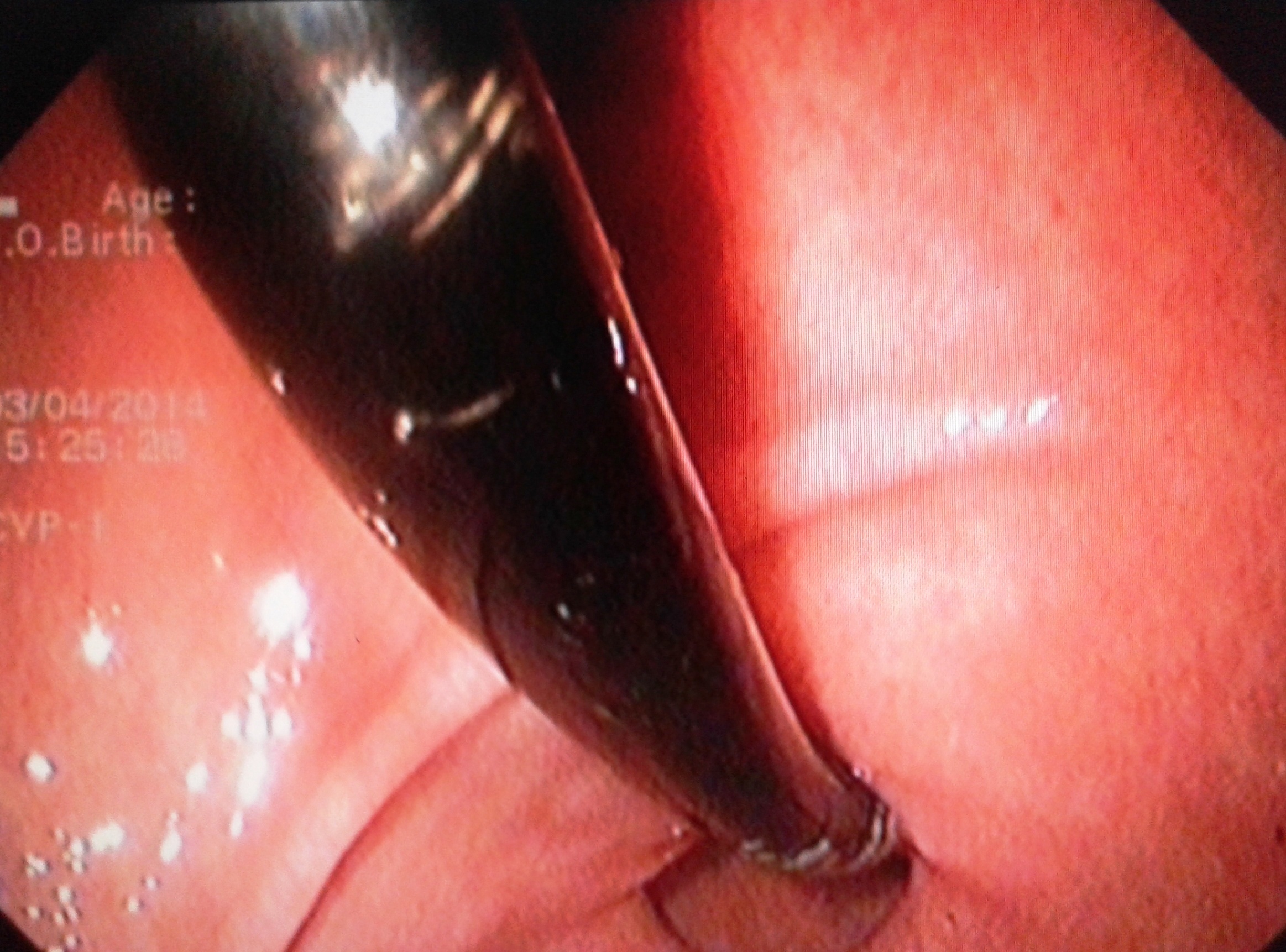 Gap soi day dien dai 40 cm trong bung nguoi dan ong hinh anh