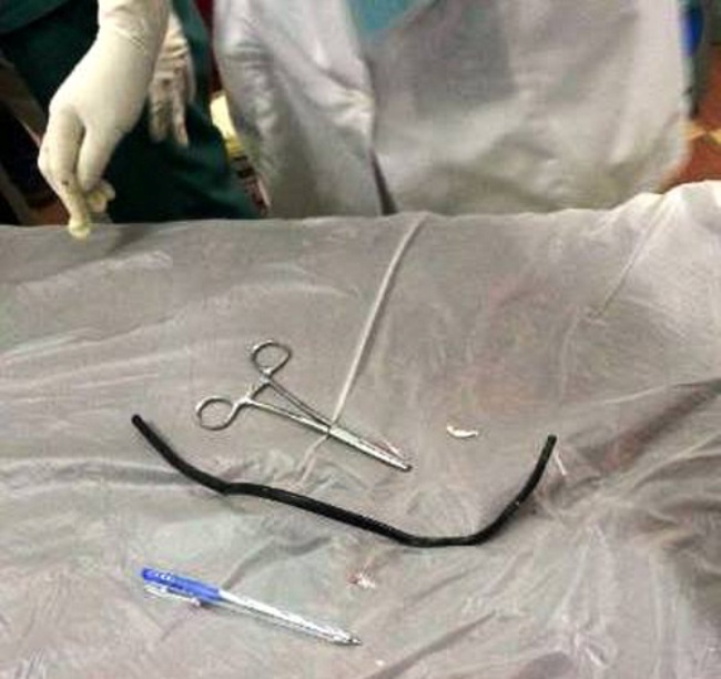 Sợi dây điện gắp ra từ bụng anh Phú.