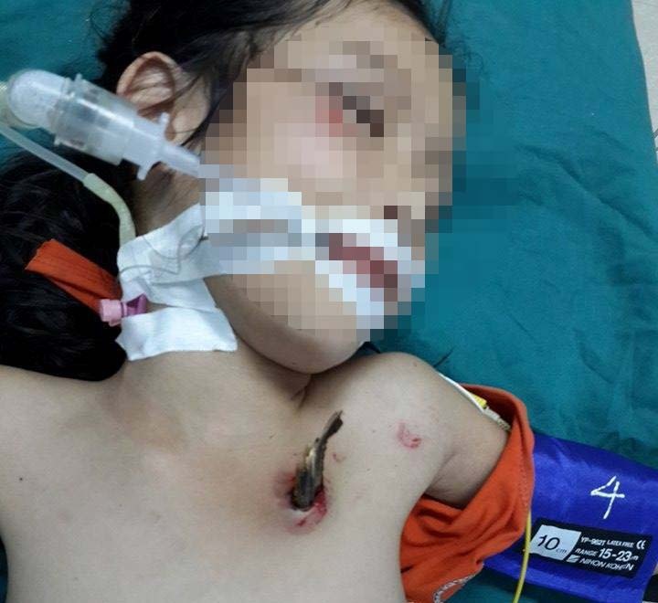 Cuu song chau be 5 tuoi bi dam thung phoi hinh anh